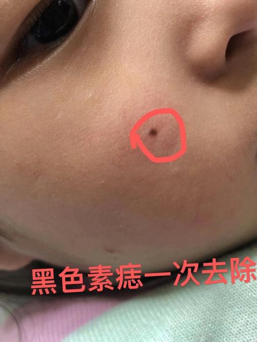 脸上痣怎么消除