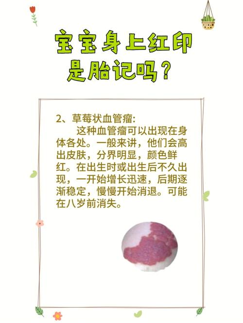不同位置的胎记代表的含义是什么?
