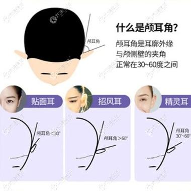 招风耳和招财耳的区别
