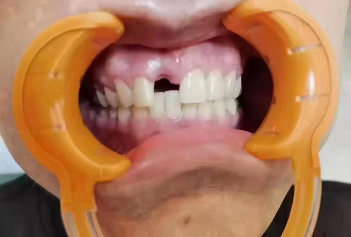 牙齿稀疏面相分析