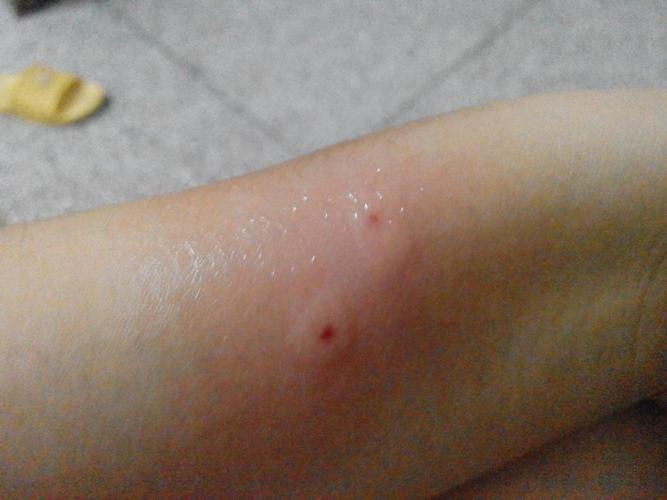 梦见蝙蝠咬我手