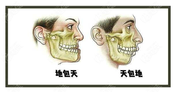 面相如何看天包地和地包天