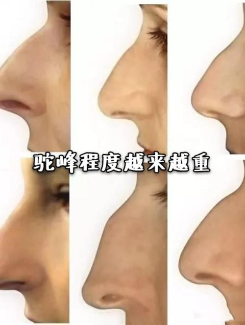 驼峰鼻的男人面相详解