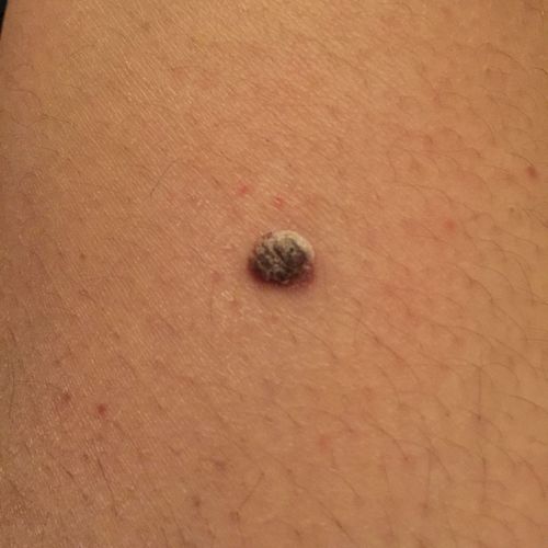 大腿上长个黑痣会痒什么情况