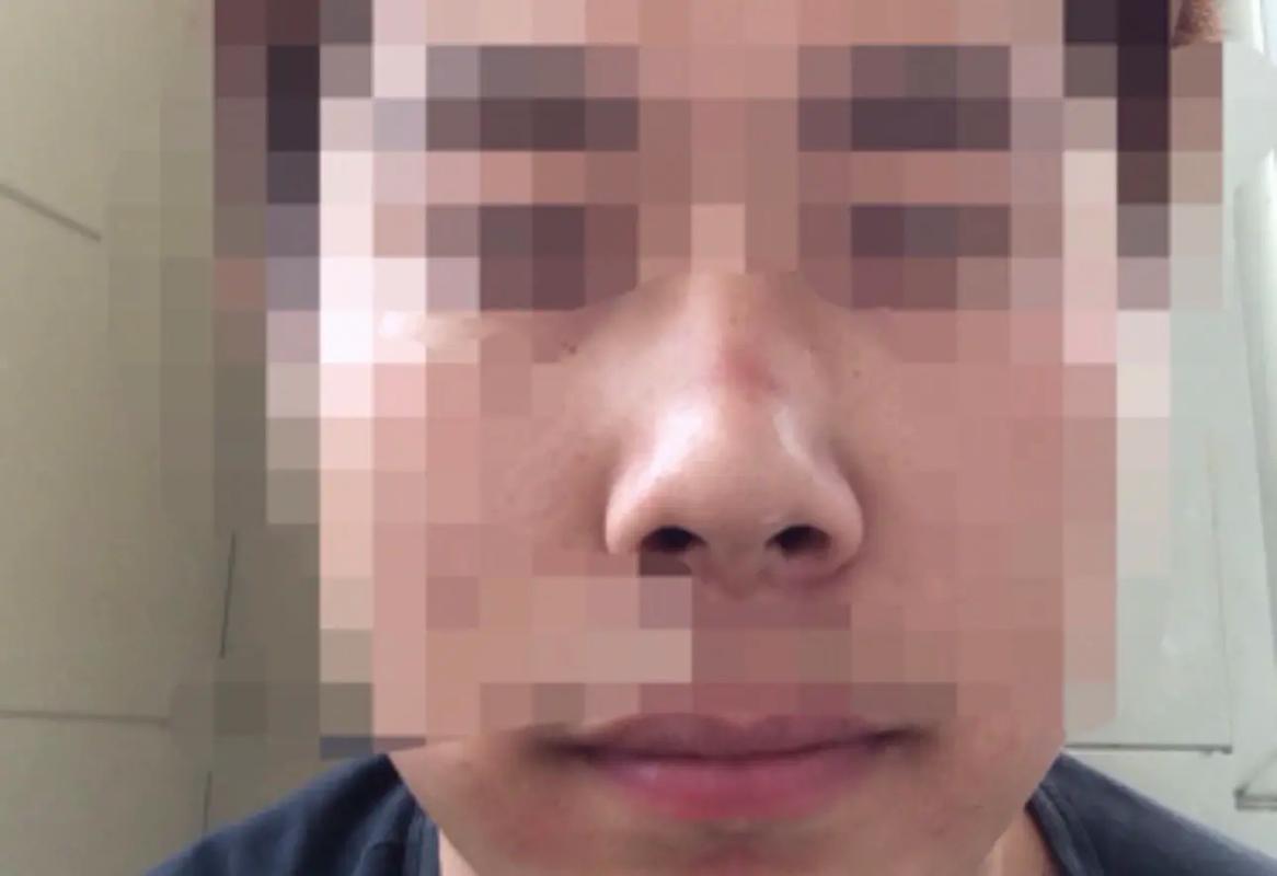 鼻子有疤的面相代表什么含义解析