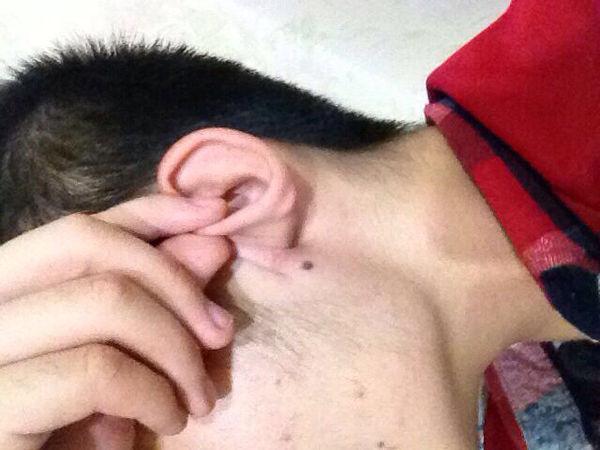 耳垂下面长了个痣