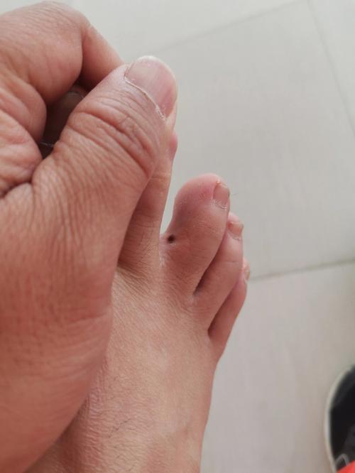 小脚趾长痣代表什么