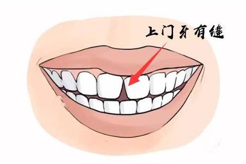门牙有缝的人有旺夫运吗