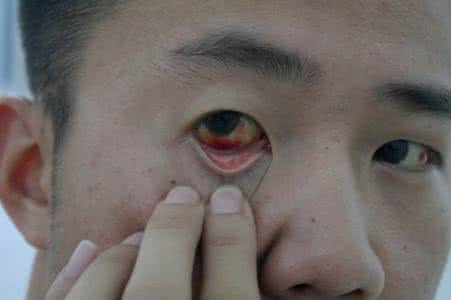 眼睛 眼睛模糊看不清是怎么回事