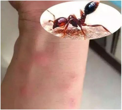 梦见蚂蚁咬浑身痒