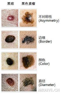 痦子是痣吗 和痣的区别