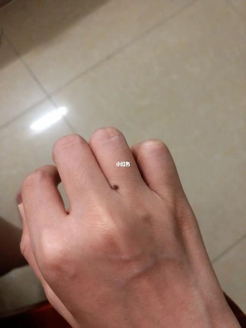 指缝长痣是什么意思