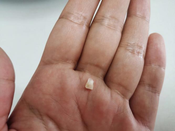 牙齿掉了是不是不吉利