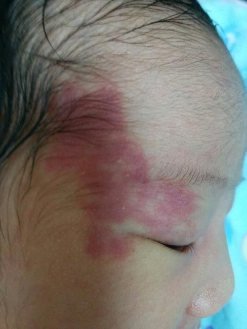 新生儿怎么辨别是不是胎记