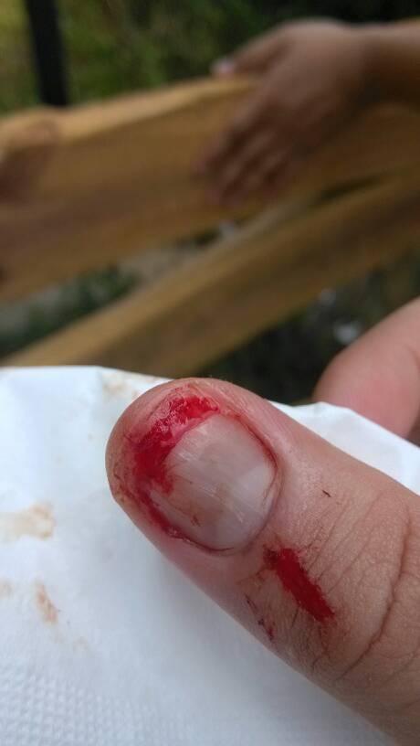 梦见自己手指甲断了