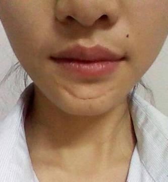 下巴有疤面相对命运有何而影响?