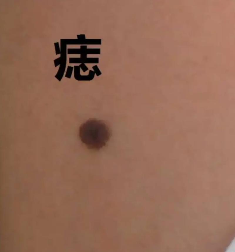 脸上黑痣算命图解吉凶
