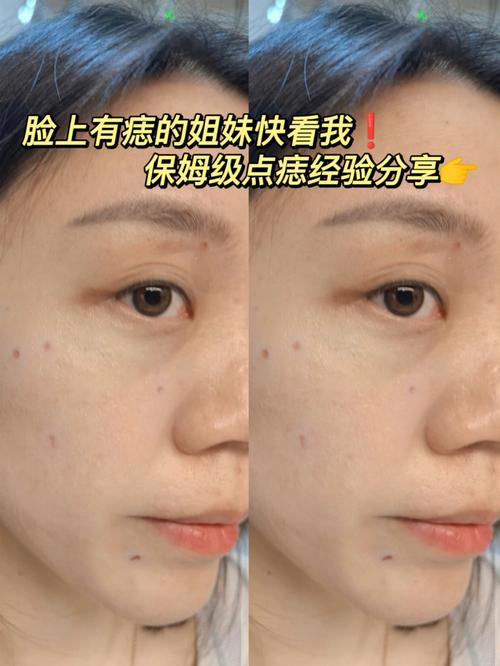 脸上痣多的人代表什么