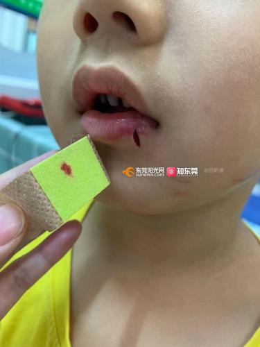 少年时代嘴唇破相