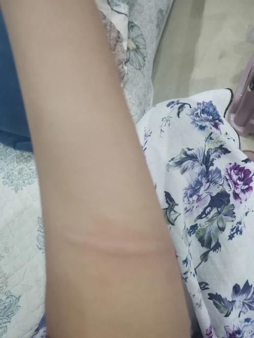 梦见被狗咬胳膊
