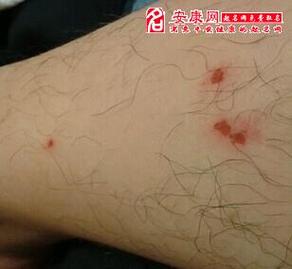 梦见狗咬腿出血