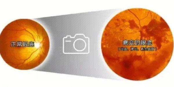 眼底有痣代表什么