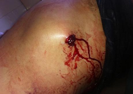 梦见腹部 梦见腹部受伤流血
