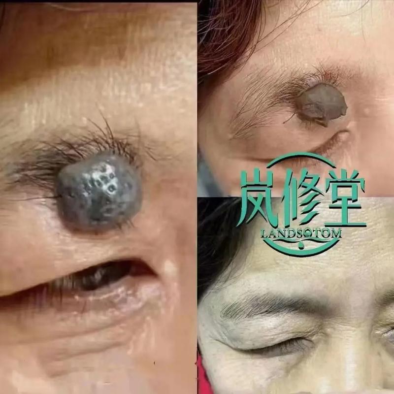 脸颊上长痣是吉是凶
