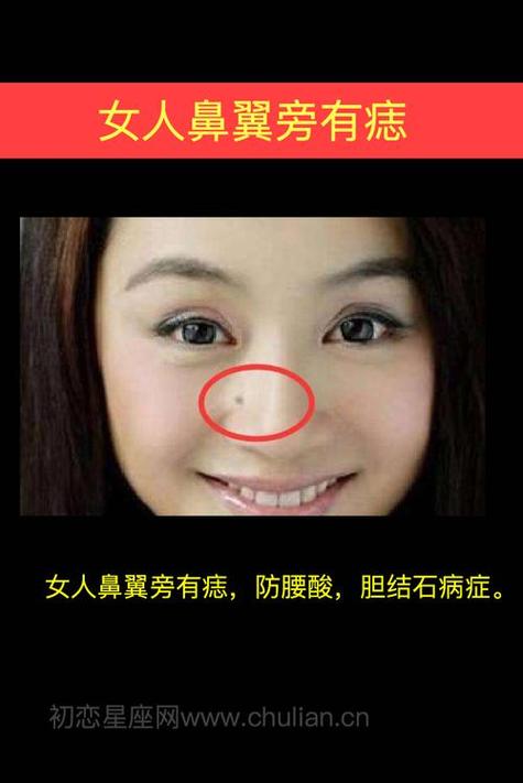 鼻翼两侧长痣 鼻翼两侧有痣好不好
