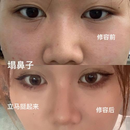 塌鼻子怎么改善塌鼻子如何变挺