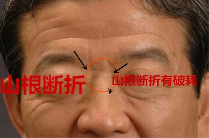 山根断裂的面相