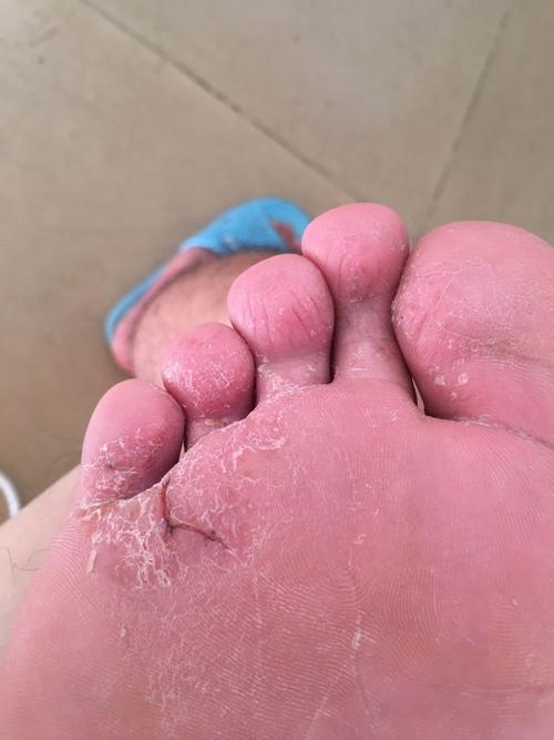 梦见脚底开裂