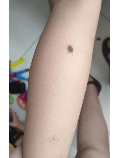 小腿上有痣的人命途坎坷是真的吗?