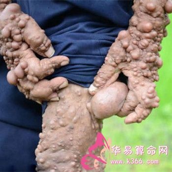 梦见身上长瘤