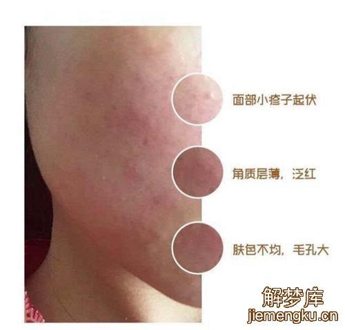 梦见癣