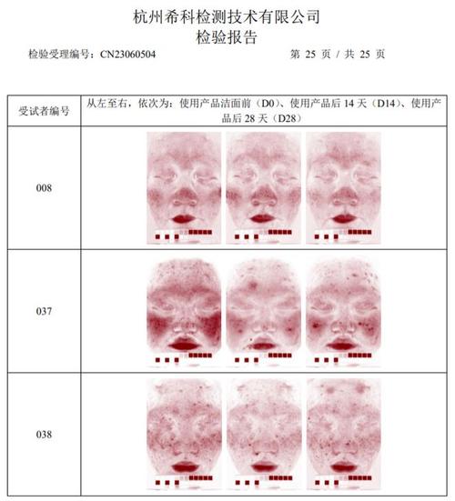 妊娠线没有正常吗?因人而异的皮肤问题