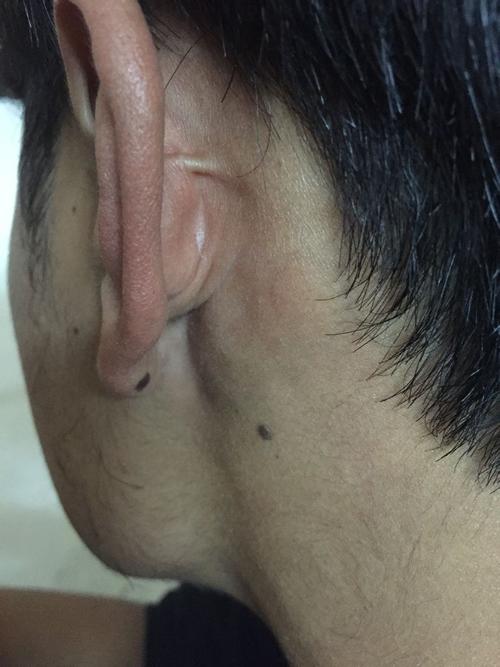 男人耳朵后面长痣好吗