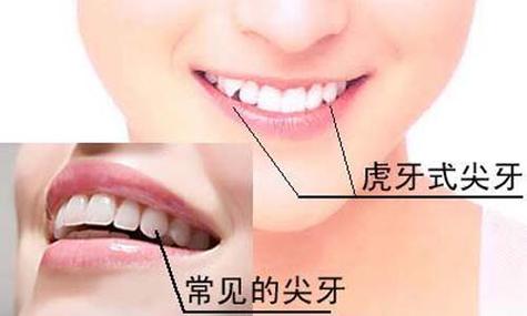 面相解析:长虎牙有什么说法