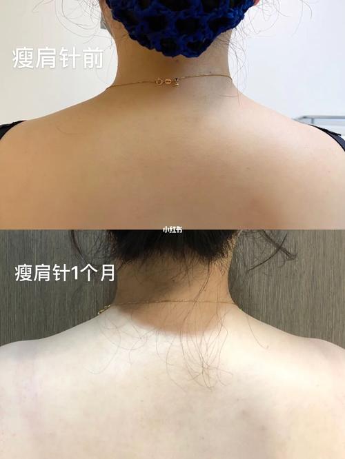 梦见妈妈肩膀里长瘤