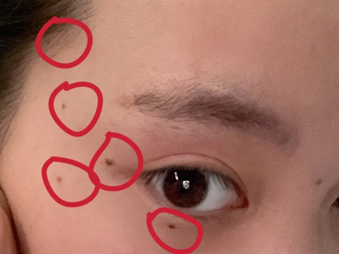 泪痣千万不能去掉吗