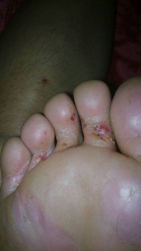 梦见脚烂 周公解梦之梦到脚烂