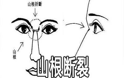 山根折断的面相是属于丧偶相吗