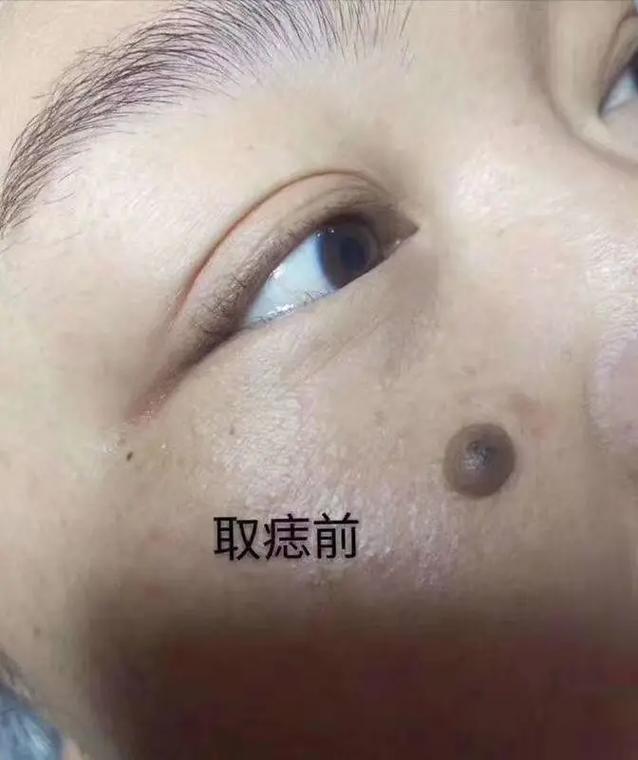 与皮肤相平的痣怎么去掉