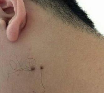 脖子上痣上长毛好不好