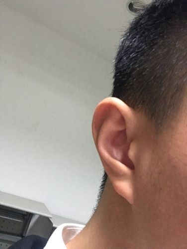 两边耳朵轮廓不一样