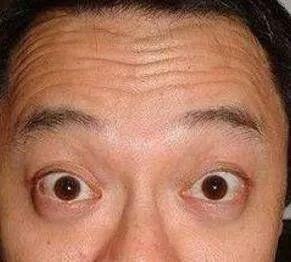 有抬头纹的人是不是命苦