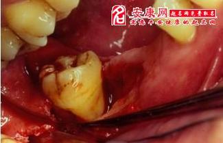 梦见牙齿松动出血