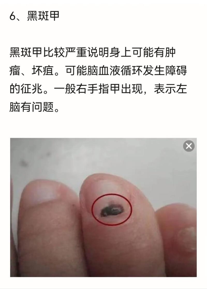 从指甲的纹理来看看自己的运气如何
