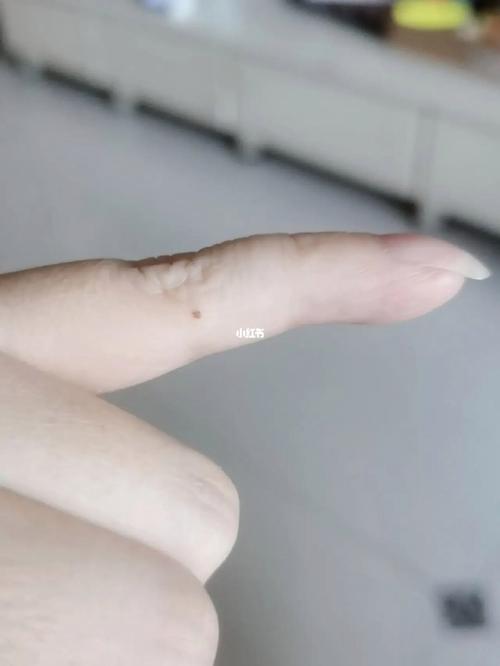 左手小拇指上有痣的命理