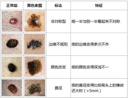 女人花丨有“痣”不在年高,有些痣要当心